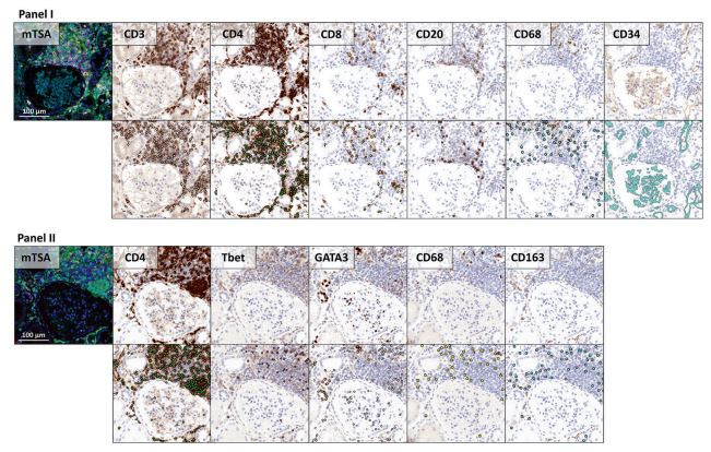 Fig. 2 Regions from two mTSA-stained slides, displaying the multiplex IHC and the artificial brightfield representation for every antibody. Fig. 2 Regions from two mTSA-stained slides, displaying the multiplex IHC and the artificial brightfield representation for every antibody.