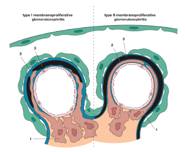 Pathological patterns of type Ⅰ and type Ⅱ MPGN[4]